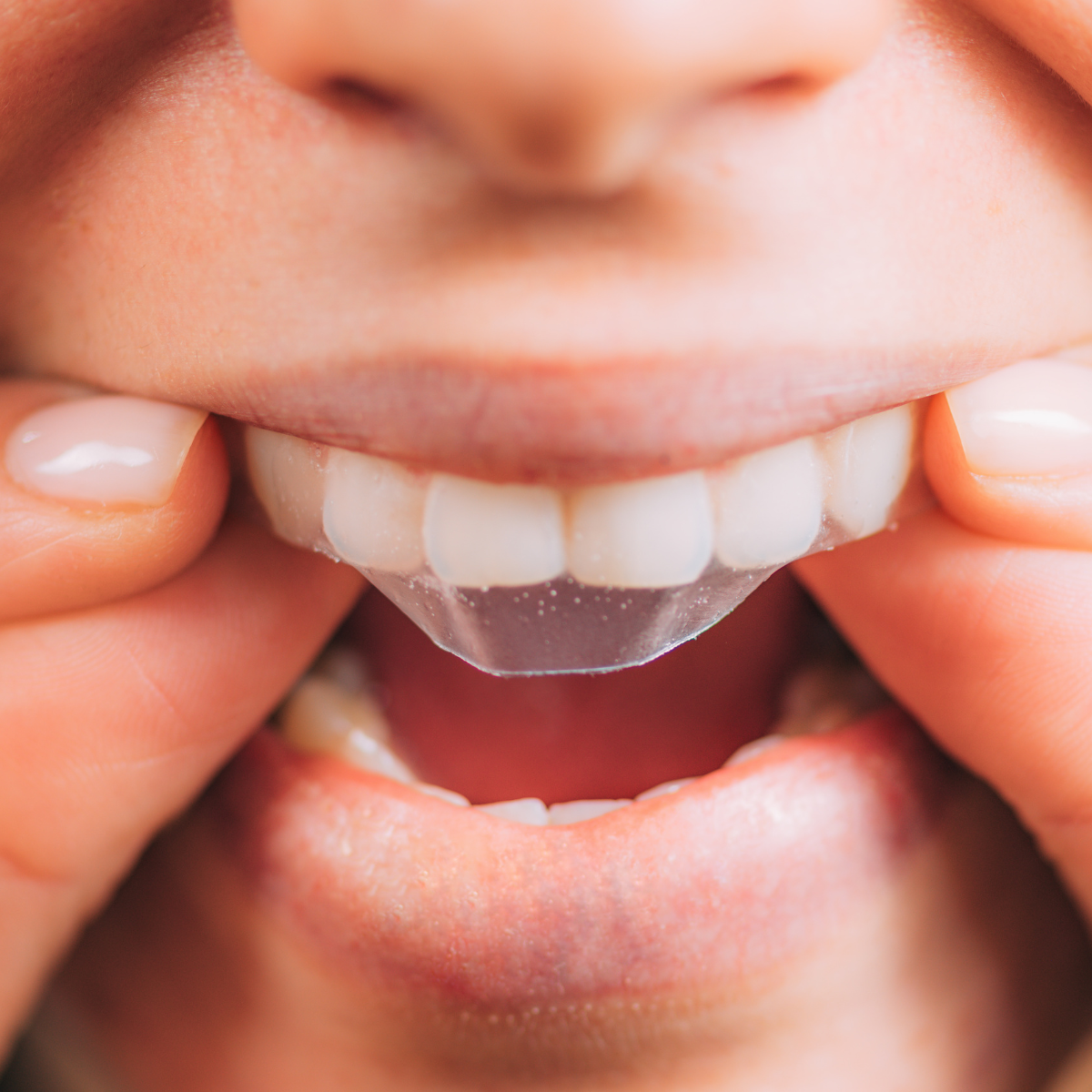 Crest 3D Whitestrips Vivid - Pokročilé bělení zubů doma